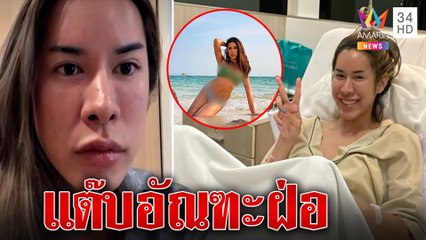 อุทาหรณ์สาวสองแต๊บเก็บทรงเส้นเลือดเลี้ยงอัณฑะตีบทำบวมเท่าไข่ไก่ หมอสั่งตัดทิ้ง |ทุบโต๊ะข่าว|07/01/66