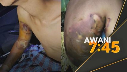 Pengabaian | Polis siasat ibu bapa, anak melecur hampir seluruh badan