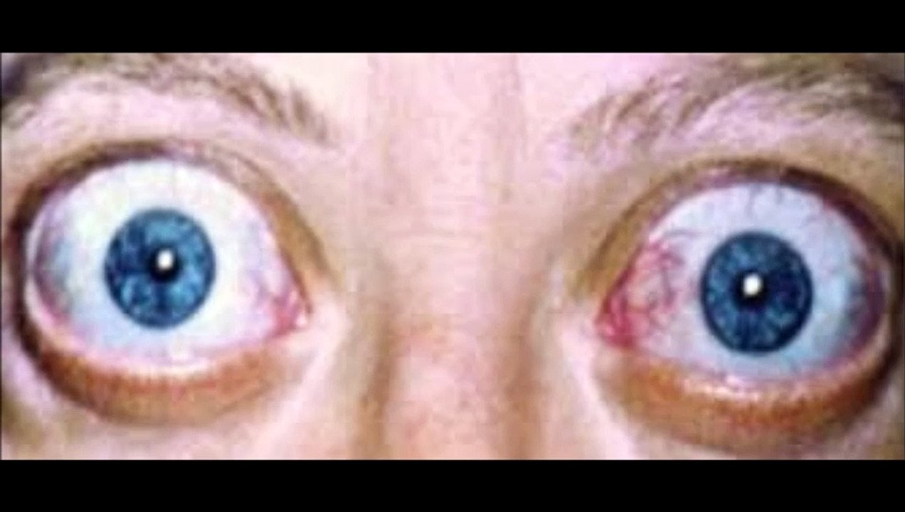 exophtalmie traitée par graisseuse orbitaire, explications Vladimir Mitz Vidéo