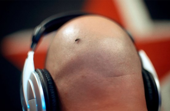 Fizzy beverages can increase men's hair loss