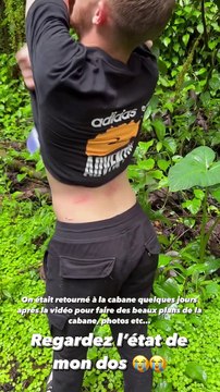 Michou dévoile son dos parsemé de piqures de moustiques - Instagram