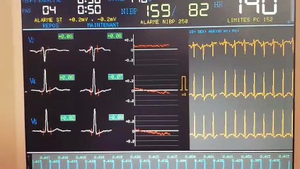 714 COMMENT SOIGNER NATURELLEMENT EXTRASYSTOLES A L EFFORT SUR COEUR NORMAL