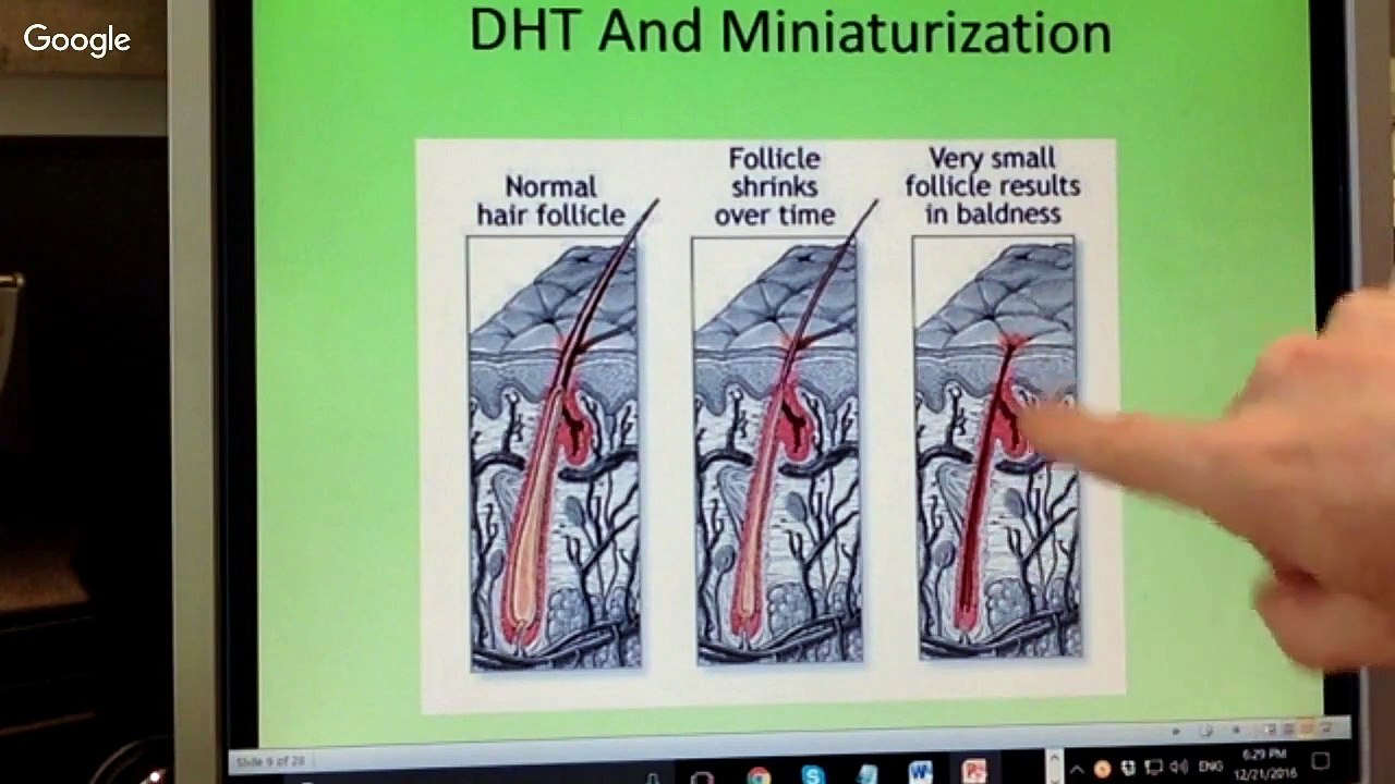 Why Common Hair Loss Treatments may not be the Best Option for you