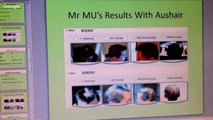 Perth Seminar Invitation for hair loss suffers