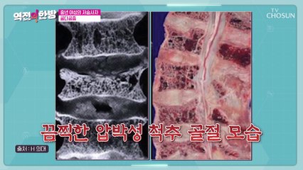 여성에게 취약하며  해마다 증가는 골다공증 TV CHOSUN 20230113 방송