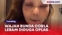 Wajah Bunda Corla Lebam-lebam Diduga Oplas, Warganet Gak Respek Lagi dan Pilih Unfollow