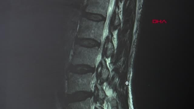 İSTANBUL-DÜNYADA İLK, TÜRK HEKİMLER İSPATLADI: TİROİD HASTALIKLARI OMURGA HASARINA YOL AÇIYOR