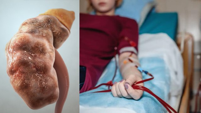 खराब किडनी ठीक हो सकती है क्या | खराब किडनी ठीक कैसे करें | Kharab Kidney Thik Ho Sakti Hai Kya