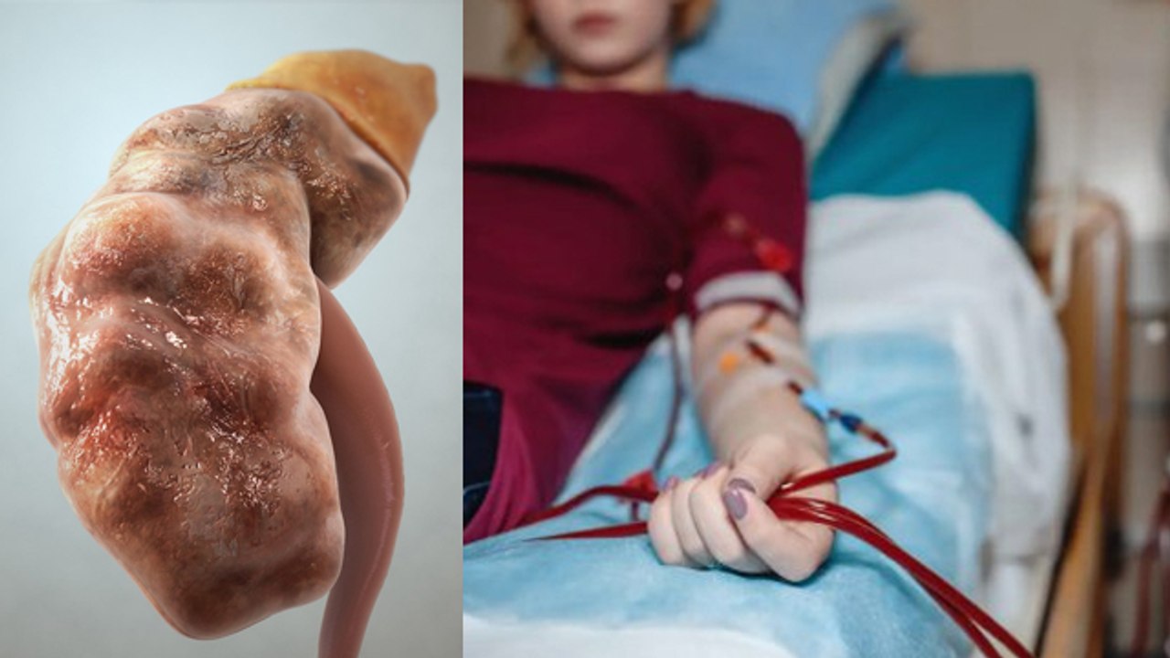 खराब किडनी ठीक हो सकती है क्या | खराब किडनी ठीक कैसे करें | Kharab Kidney Thik Ho Sakti Hai Kya