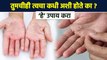 त्वचा का निघते? | How to Get Rid of Skin Peeling | Skin Peeling Treatment at Home | Lokmat Sakhi RI3