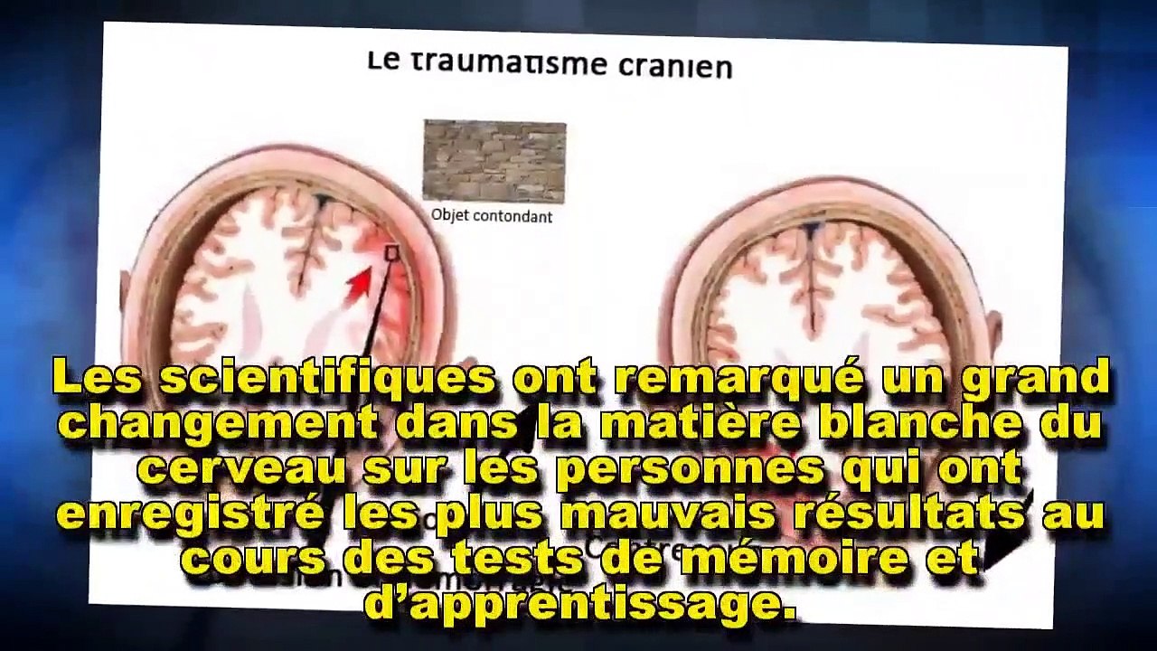 Quel impact ont les coups légers sur le cerveau _