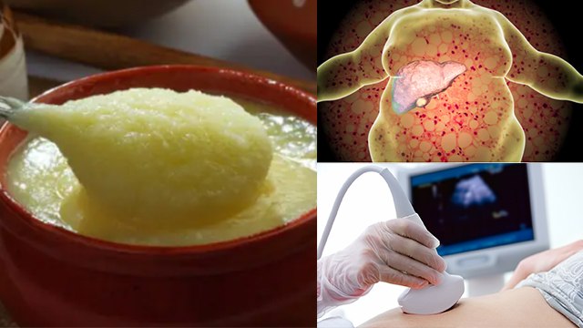 फैटी लिवर में घी खाना चाहिए कि नहीं | Fatty Liver Me Ghee Khana Chahiye Ki Nahi | Boldsky