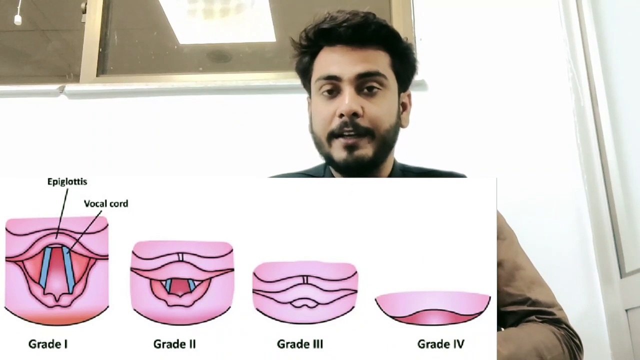 Cotman and lehans laryngoscopy Grading in Urdu Hindi by Anesthesia Technologist video Dailymotion