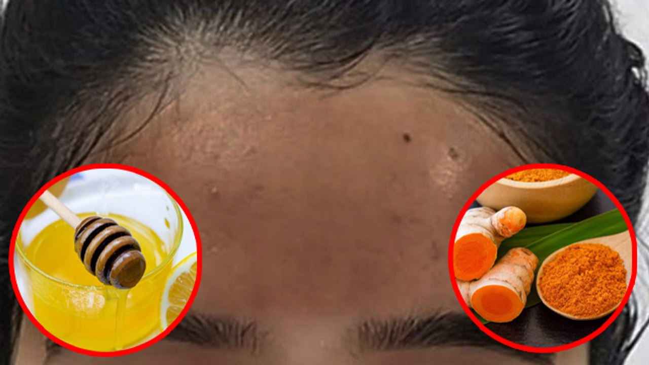 माथे का कालापन कैसे दूर करें । Mathe Ka Kalapan Kaise Door Kare । Boldsky