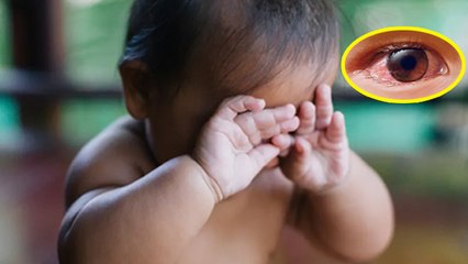 Conjunctivitis In Babies: Baby Pink या Red Eye Home Remedy | बच्चे की आंख लाल होने पर क्या करें