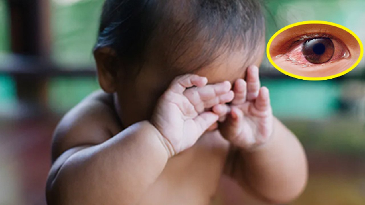 Conjunctivitis In Babies: Baby Pink या Red Eye...
