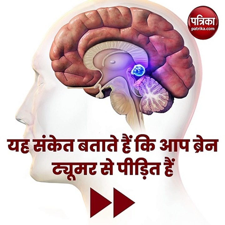 Symptoms of brain tumor : यह संकेत बताते हैं कि आप ब्रेन ट्यूमर से पीड़ित हैं