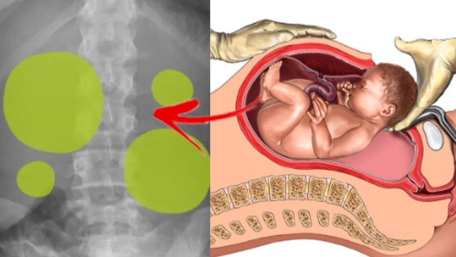 Delivery के बाद Fart करना जरूरी क्यों | Delivery Ke Baad Gas Pass Karna Jaruri Kyu | Boldsky