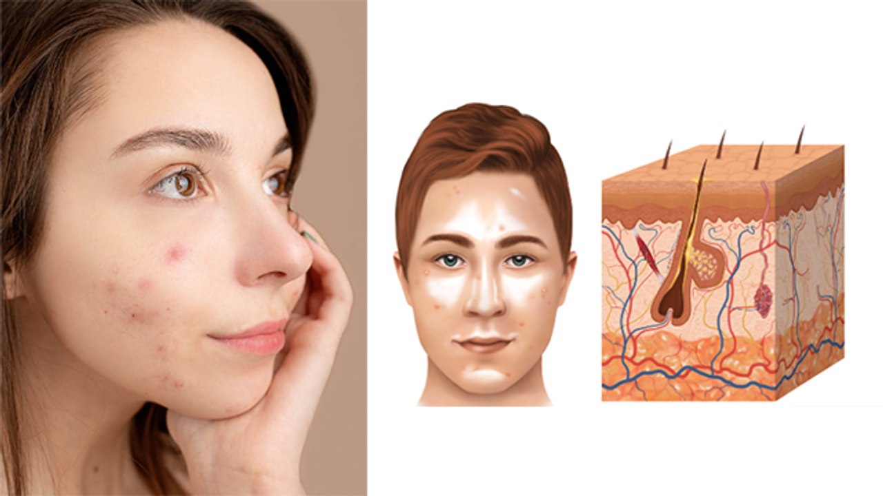 बरसात में पिंपल क्यों होता है Barsat Me Pimple Kyu Hota Hai Monsoon Acne Reason Boldsky