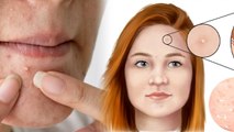 चेहरे पर सफ़ेद दाने क्यों होते है , चेहरे पर सफ़ेद दाने होने का कारण और उपाय | Boldsky*Health