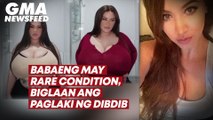 Babaeng may rare condition, biglaan ang paglaki ng dibdib | GMA News Feed