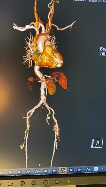 AORT KAPAK DEĞİŞİMİ