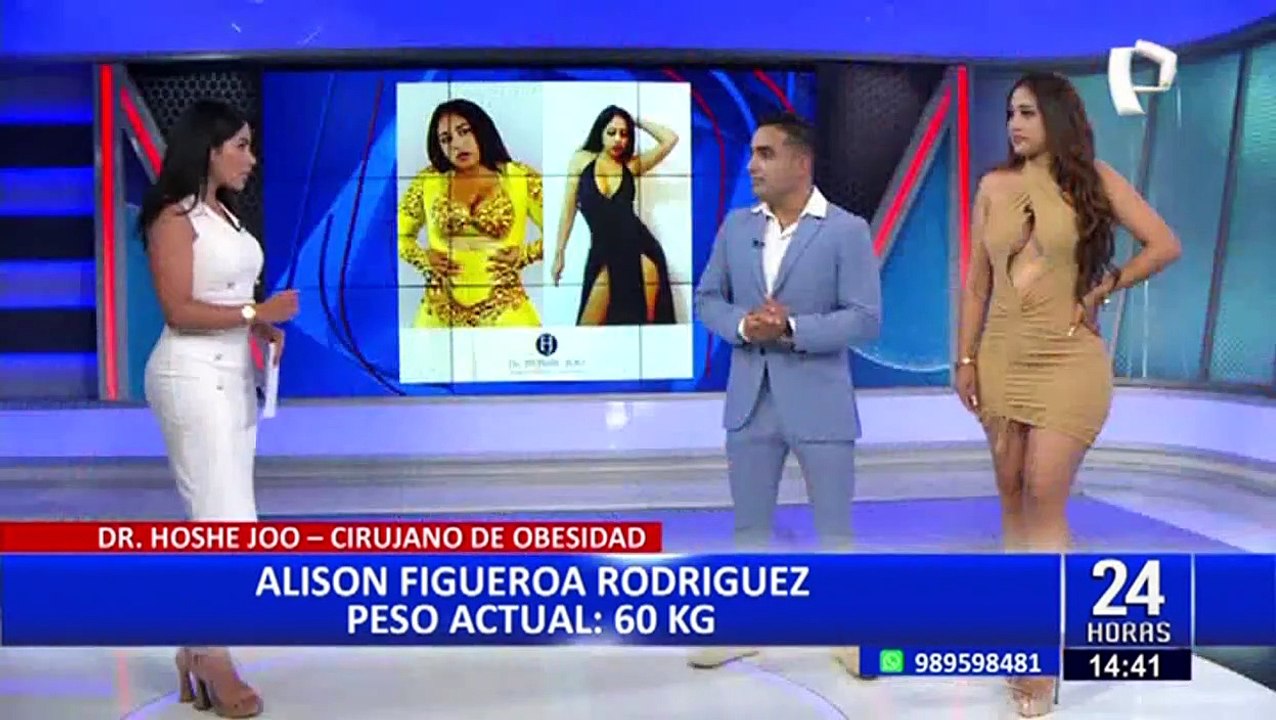 Conozca todo sobre la cirugía de la manga gástrica para bajar de peso