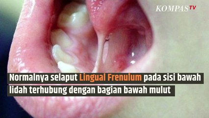 Ayah dan Bunda Waspada Ya, Si Baby Bisa Terkena Kelainan Ini Lho | SINAU