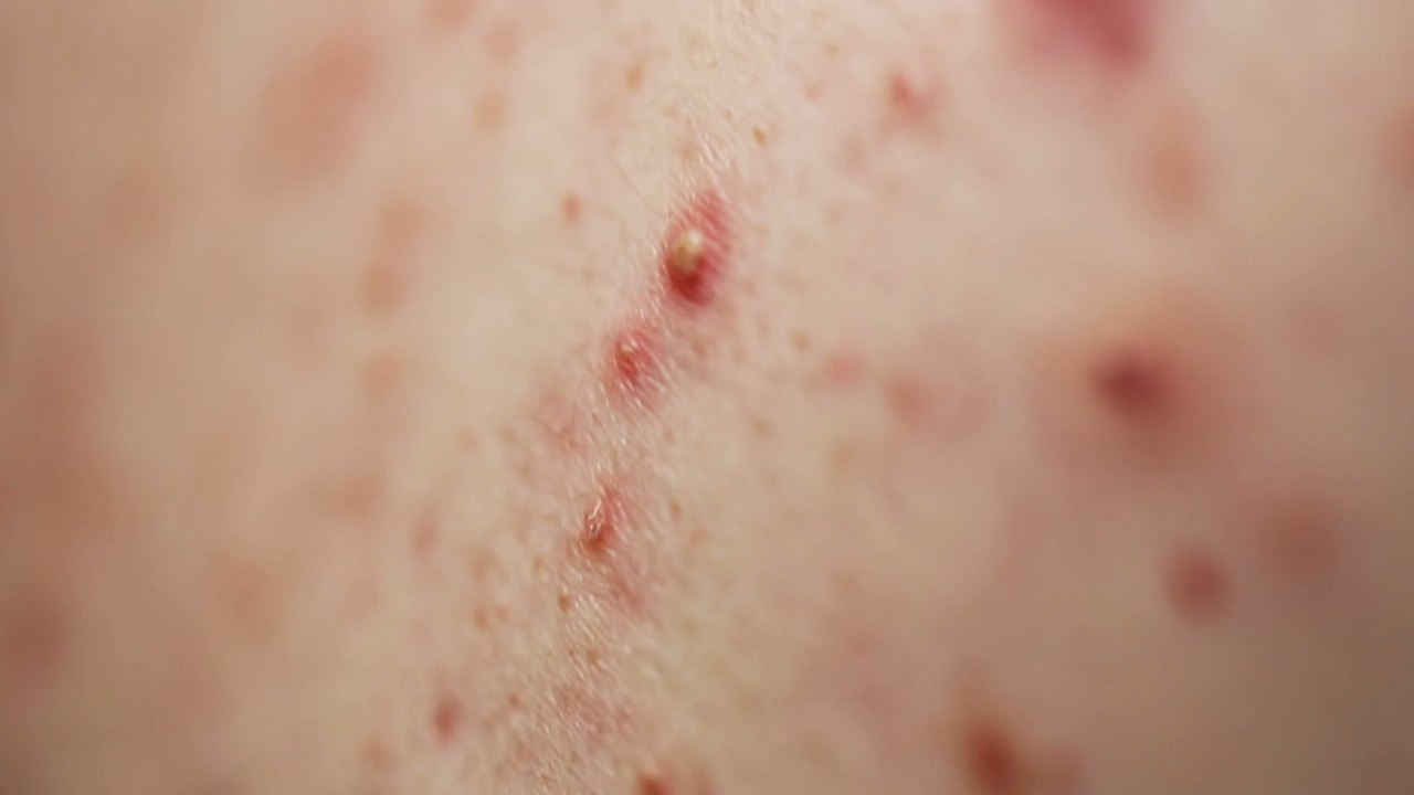Chicken pox: You can get the contagious infection more than once, here’s how