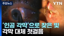 '인공 각막'으로 찾은 빛...각막 대체 첫 걸음 / YTN