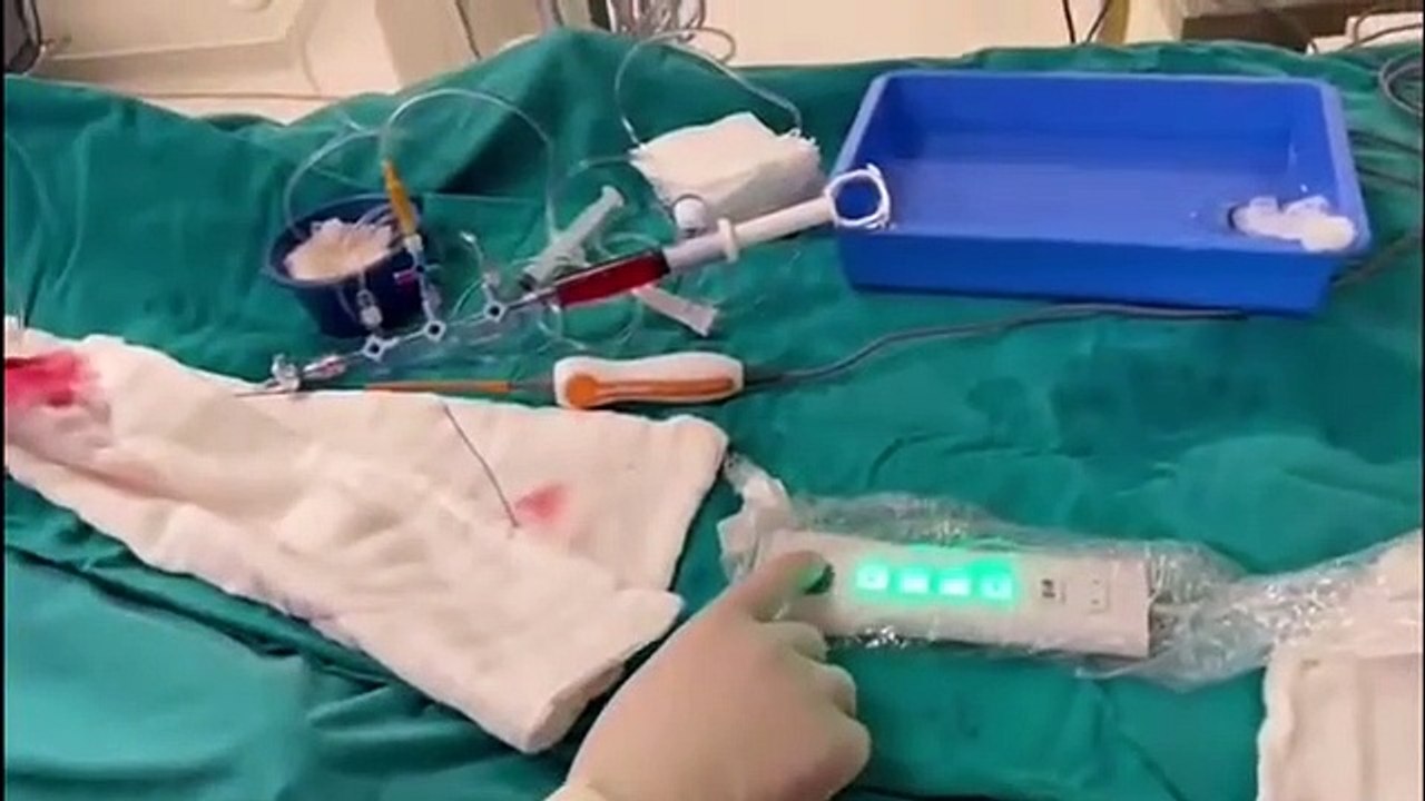 RENAL DENERVASYON