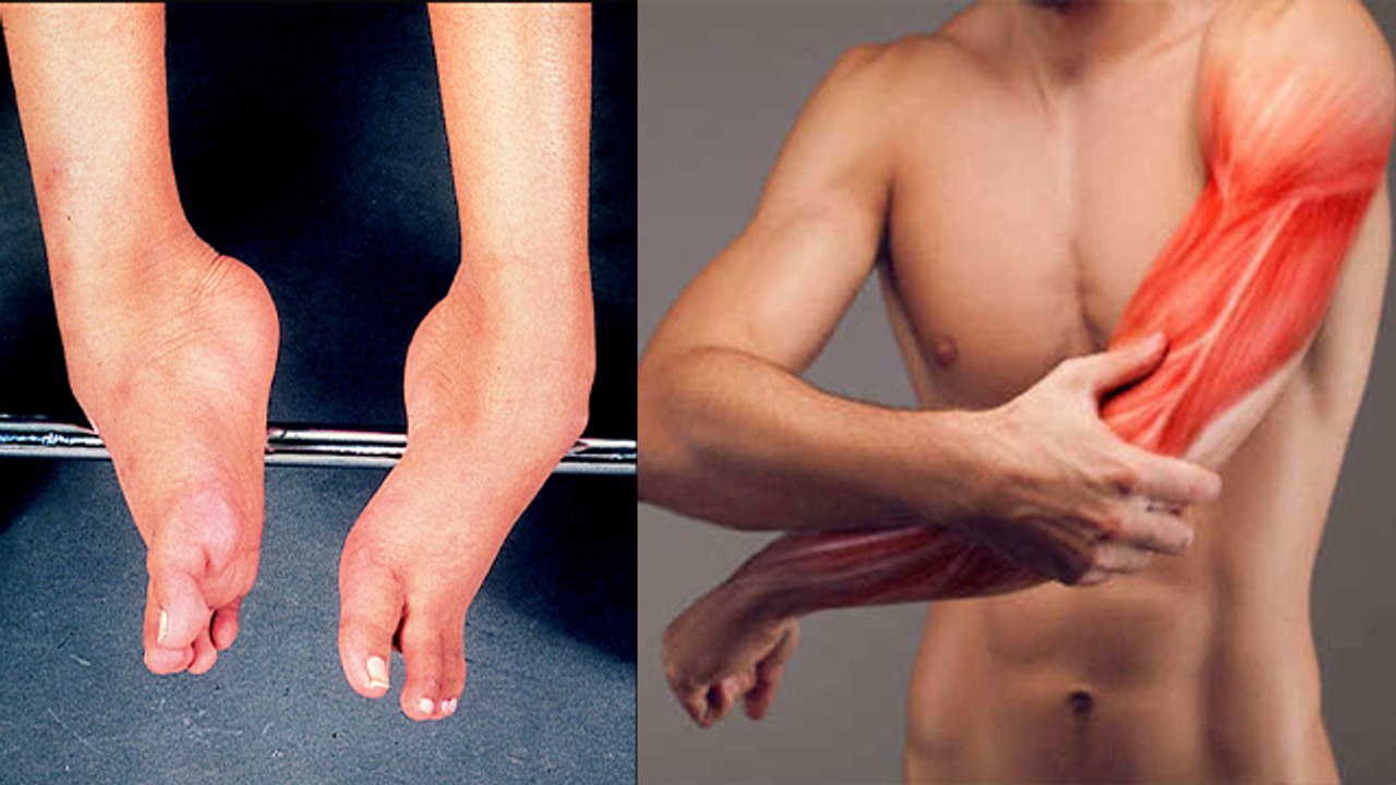 Muscular Dystrophy क्या होता है । मस्कुलर डिस्ट्रॉफी क्यों होती है । Boldsky *Health