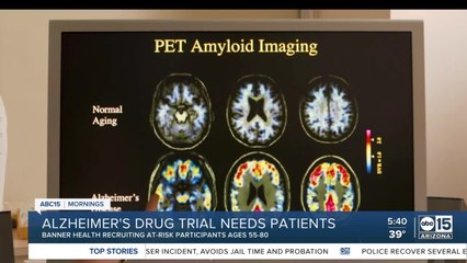 Alzheimer's drug trial needs patients