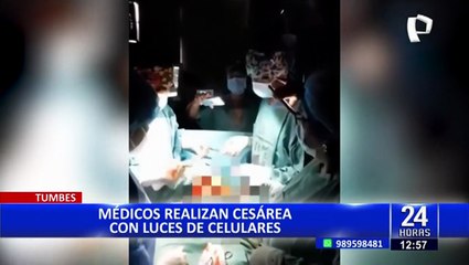 Médicos realizan cesárea alumbrándose con luces de celulares en Tumbes