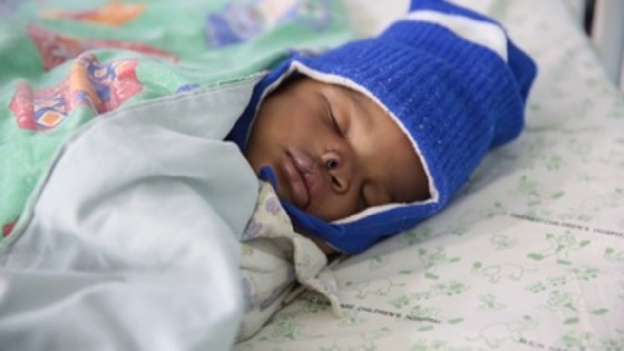 Cirugía contra el estigma de los niños con labios leporinos en Zimbabue