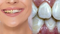 दांतों पर सफेद धब्बे क्यों होते है । दांतों पर सफेद धब्बे होने के कारण ।