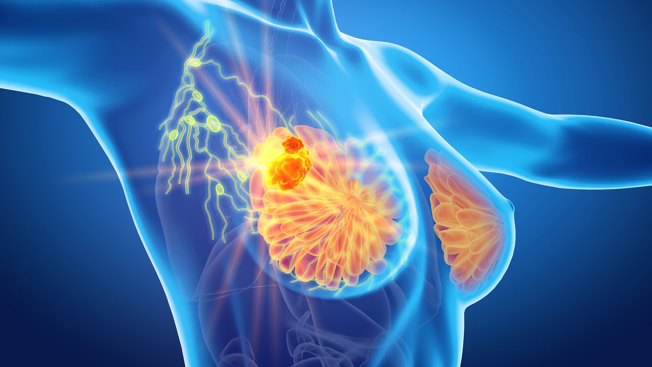 Neue Studie zeigt Erfolg: Kommt bald eine Brustkrebs-Impfung?