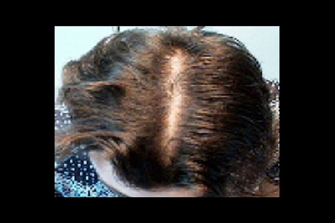 The Story of Every Hair Loss Sufferer Australian Hair _ Scalp Clinic