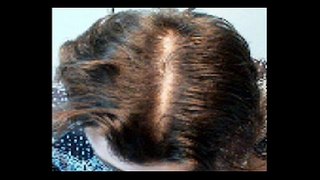 The Story of Every Hair Loss Sufferer - Australian Hair _ Scalp Clinic