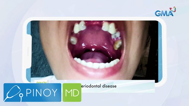 Pananakit ng ngipin, senyales ba ng iba pang karamdaman? | Pinoy MD