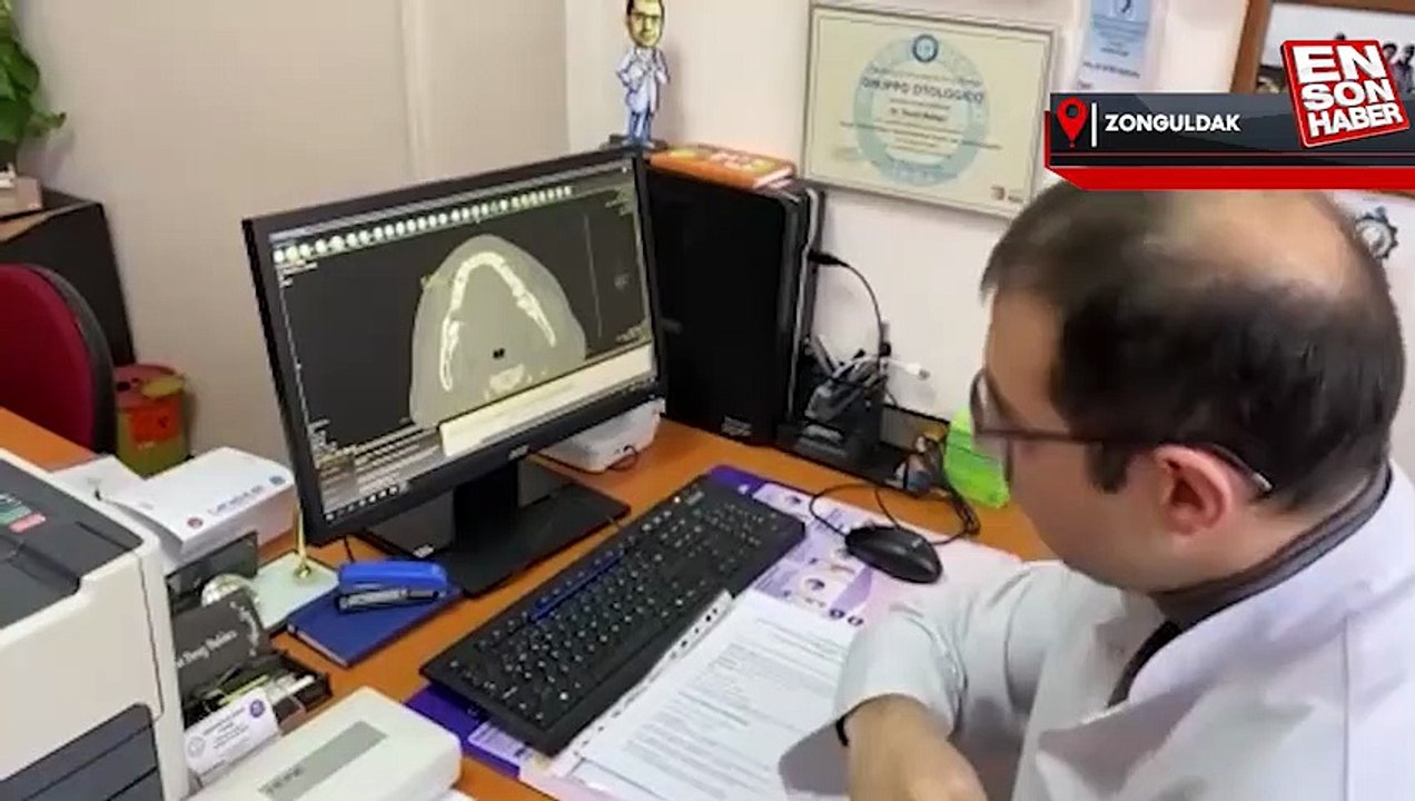 Çenesinden tümör çıkan hastaya kaval kemiğinden çene yaptılar