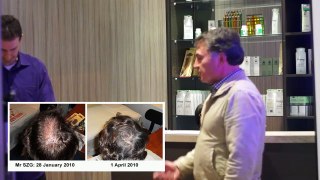 Mr SZG - Hair Loss Treatment Story