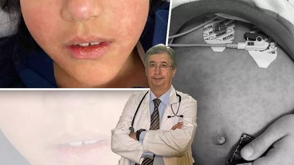 Prof. Dr. Haluk Çokuğraş: Yıllardır görmediğimiz kızamık vakaları yeniden ortaya çıktı