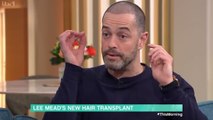 Lee Mead says hiding receding hairline 'affected confidence' before transplant