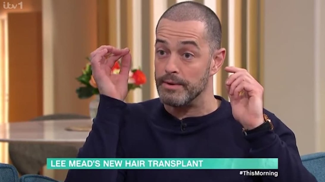 Lee Mead says hiding receding hairline 'affected confidence' before transplant