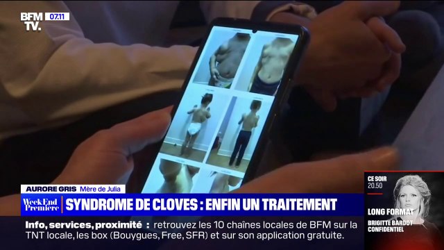 Un traitement efficace contre le syndrome de Cloves