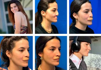 Modelo que teve o lábio arrancado por cachorro compartilha transformação após seis cirurgias