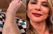 Luciana Gimenez mostra cicatrizes e desabafa um mês após grave acidente nos EUA