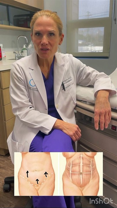 Tummy Tuck Surgery by Michigan Female Plastic Surgeon Dr Daniela Rodriguez | Abdominoplasty