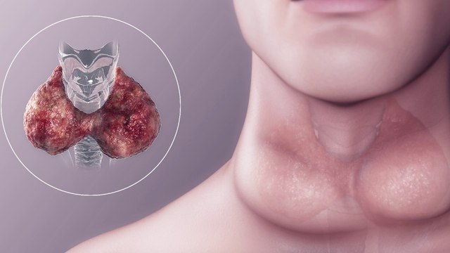 bd-historia-familiar-influye-en-casos-de-tiroides-090223